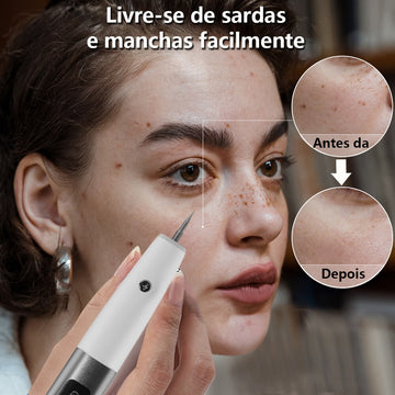 Caneta de plasma elétrica Remoção de verrugas, Sardas e Mancha  escura
